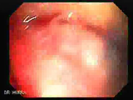 Familial Adenomatous Polyposis (26 of 36)