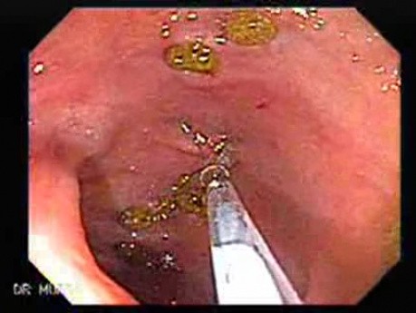 Acute Diverticulitis (4 of 5)