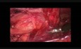 Laparoscopic TAPP hernia repair using 3D mesh