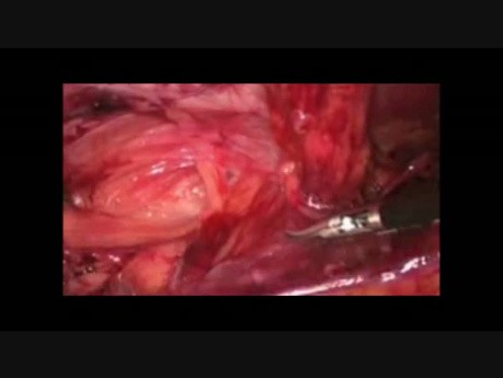 Laparoscopic TAPP hernia repair using 3D mesh