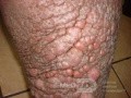 Elephantiasis nostras verrucosa on the legs with morbid
 obesity (2 of 5)