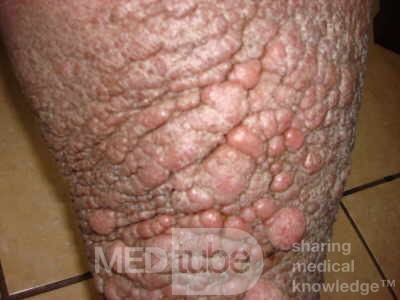 Elephantiasis nostras verrucosa on the legs with morbid
 obesity (2 of 5)