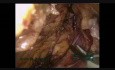 Resection Of Hepatic Flexure Carcinoma - Laparoscopic Extended Right Hemicolectomy