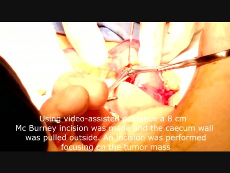 Laparoscopic Assisted Local Resection of a Large Caecum Lipoma