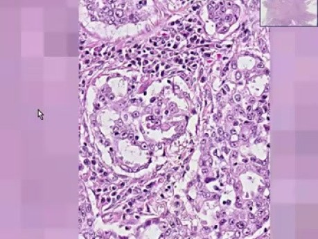 Adenocarcinoma - Histopathology - Lung