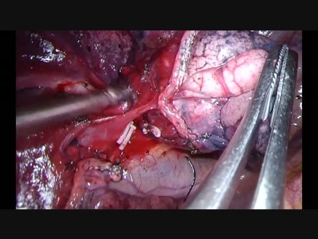 Uniportal VATS Right Anterior Segmentectomy S3