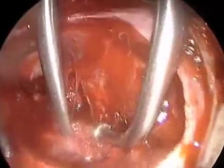Endoscopic Removal of Pituitary Tumor Causing Hydrocephalus