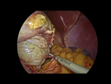 Laparoscopic Resection Of Gastric GIST (Gastro-Intestinal Stromal Tumor)