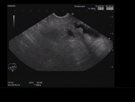 Endoscopic Ultrasound of Early Ampullary Tumor