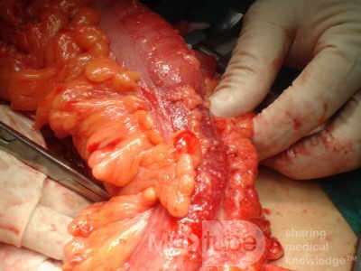 Adenocarcinoma of the Transverse Colon (12 of 15)