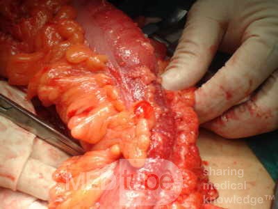 Adenocarcinoma of the Transverse Colon (12 of 15)