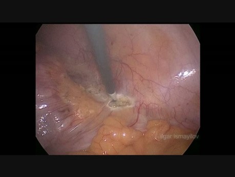 Laparoscopic Left Hemicolectomy for Polyposis