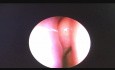 Nasal Foreign Body. Button Battery