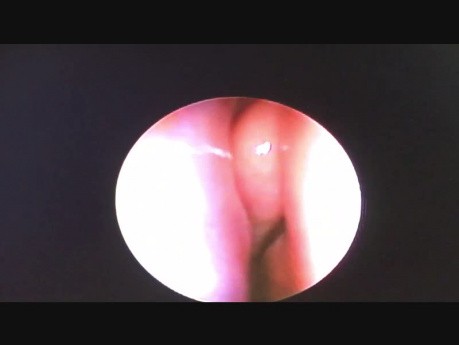 Nasal Foreign Body. Button Battery