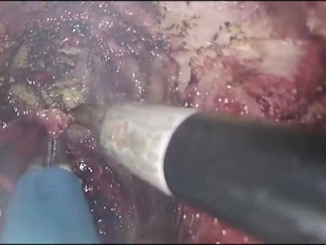 TAMIS Proctectomy with Turnbull-Cutait Pull-Through Coloanal Anastomosis for Rectourethral Fistulas