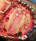 Surgical Planning with Neuronavigator in Patient with Intracranial Mass Lesion. High Grade Glioma.