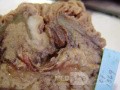 Cholangiocarcinoma that infiltrated a Periampullary Duodenal Diverticula and the head of the pancreas (8 of 20)