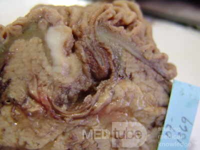 Cholangiocarcinoma that infiltrated a Periampullary Duodenal Diverticula and the head of the pancreas (8 of 20)