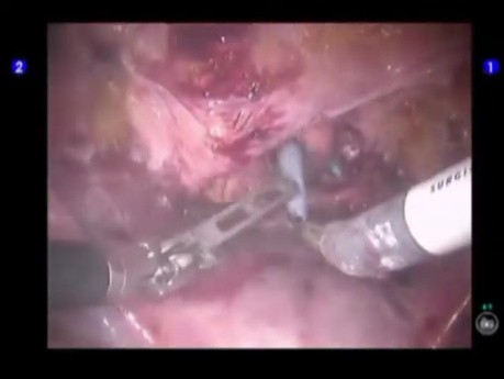 Urinary Bladder Endoscopy