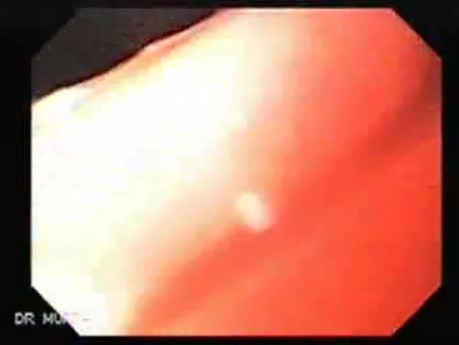 Squamous cell carcinoma of the larynx (4 of 4)