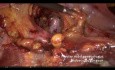 Pelvic Lymphadenectomy 