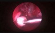 Glomangiopericitoma Nasal, Rare Tumor