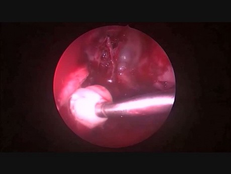 Glomangiopericitoma Nasal, Rare Tumor