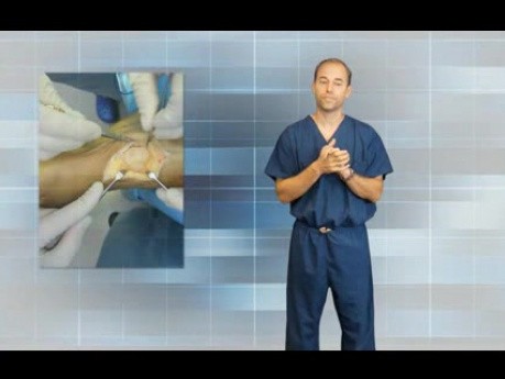 Ganglion Cyst in Foot and Ankle