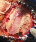 Surgical Planning with Neuronavigator in Patient with Intracranial Mass Lesion. High Grade Glioma.