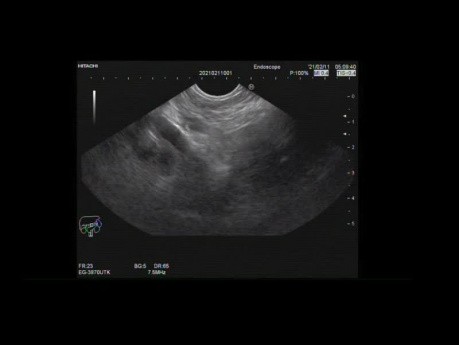 Endoscopic Ultrasound Guided FNB for Hilar Lymph Node
