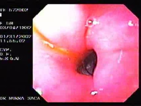 Pyloric Ulcers