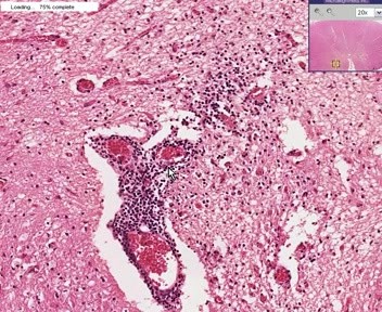 Lichen Sclerosis Et Atrophicus