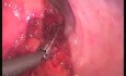 Rectopexy - SILS 