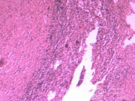 Multiple Rectal Ulcers (110 of 110)