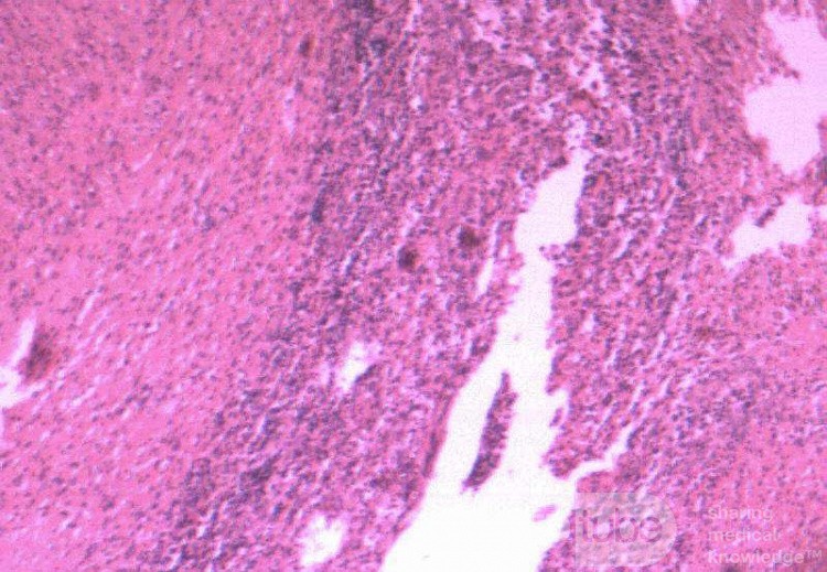 Multiple Rectal Ulcers (110 of 110)