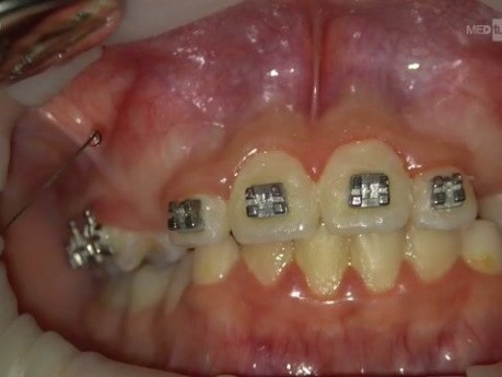 Exposure and Traction of Labial Impacted Canines, Traction by Power Chain