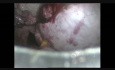 Laparoscopic Removal of a Large Ovarian Cyst Whithout Spillage