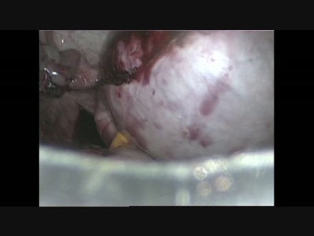 Laparoscopic Removal of a Large Ovarian Cyst Whithout Spillage