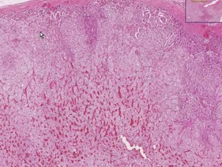 Nodular hyperplasia - Histopathology - Adrenal