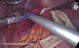 Cruroplasty in Antireflux Surgery Geometry Not Just Sutures