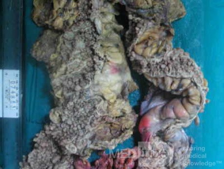 Synchronous Cancers, Familial Adenomatous Polyposis (27 of 36)