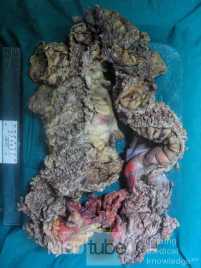 Synchronous Cancers, Familial Adenomatous Polyposis (27 of 36)