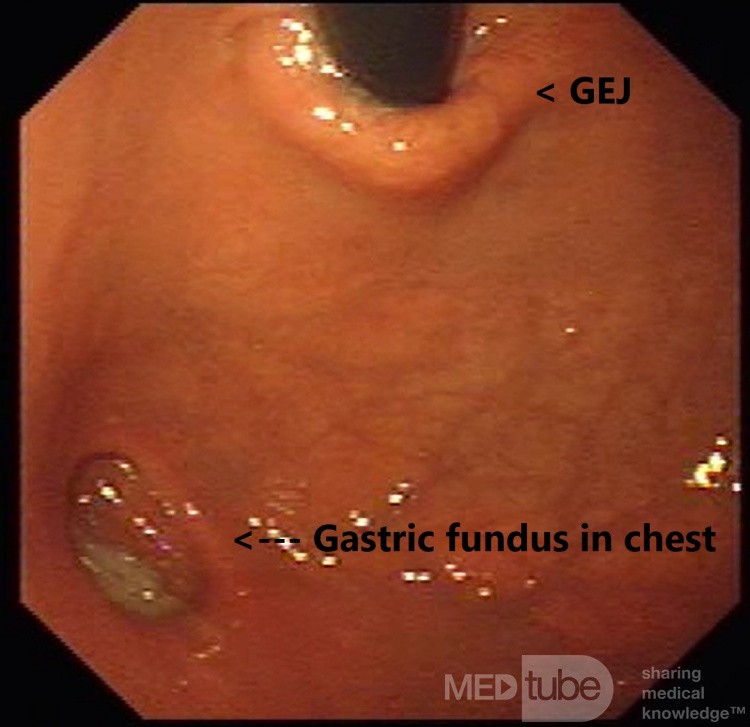 Type 2 Hiatal Hernia