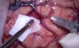 Left Atrial Meningioma. Microscopic Resection.