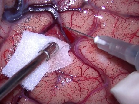 Left Atrial Meningioma. Microscopic Resection.