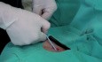 Catheter Insertion Through Subclavian Vein 