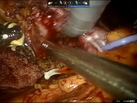 Robotic Enucleation of Renal Hilar Tumour