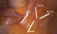 Laparoscopic Oncological Approach to Rectal CA
