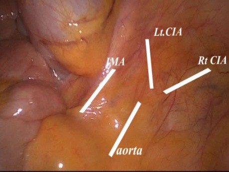 Laparoscopic Oncological Approach to Rectal CA