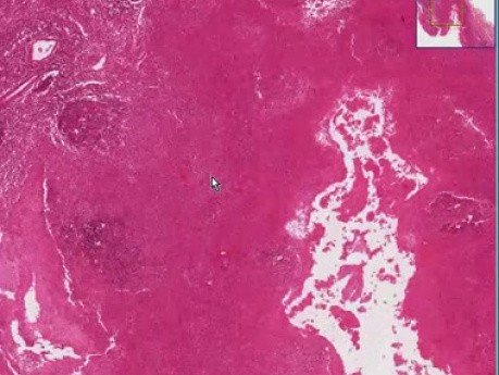 Streptococcal tonsillitis